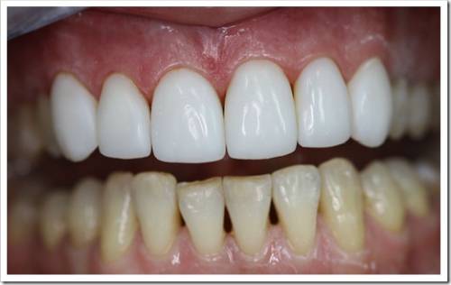 Прямой и непрямой метод эстетической стоматологии