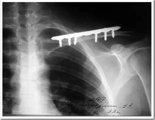Как осуществляется лечение перелома ключицы при помощи операции?