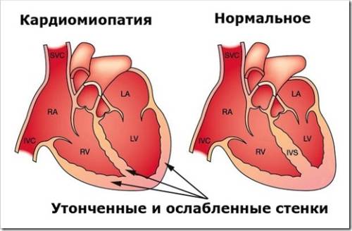 Влияние пьянства на сердце