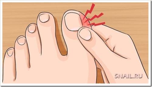 Возможные способы лечения вросшего ногтя