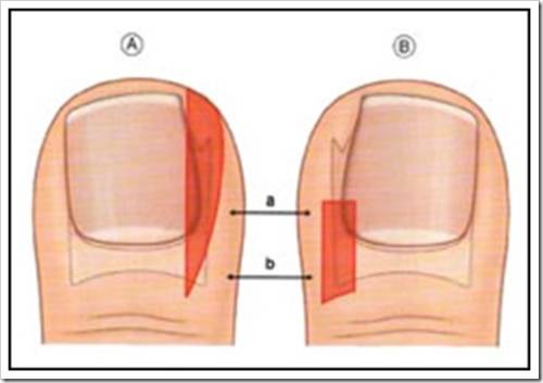 Плюсы частичного удаления вросшего ногтя