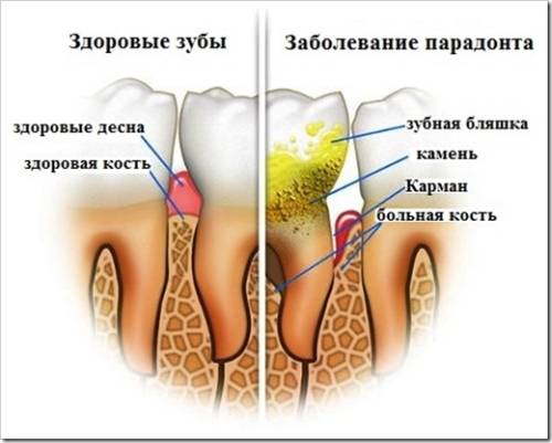 Причины появления зубного камня