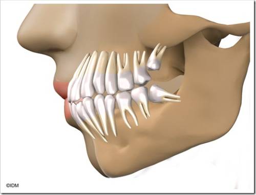 Удаление зуба мудрости, который вырос горизонтально 
