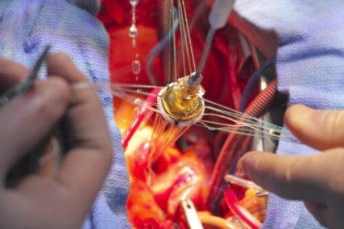 Замена клапанов на сердце: как проходит операция  