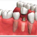 Как ставится имплант зуба