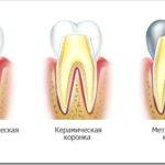 Что такое зубная коронка и какие бывают
