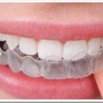 Ортодонтия без брекетов с помощью прозрачных зубных капп