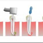 Способы пломбировки корневых каналов зубов
