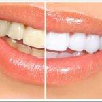Что такое отбеливание зубов и какие есть виды