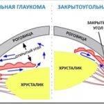 Открытоугольная глаукома: особенности заболевания, его лечение