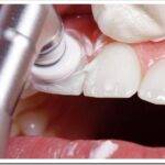 Что такое отбеливание зубов у стоматолога и как его делают