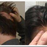 Особенности и преимущества системы замещения волос