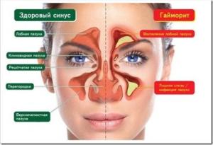 антибиотики при гайморите