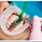 Как делают ультразвуковую чистку зубов