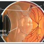 От чего бывает разрыв сетчатки глаза и какие симптомы