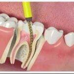 Как лечат каналы в зубе