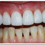 Что такое композитные виниры на зубы и как устанавливаются