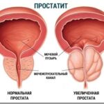 Простатит: симптомы, причины и профилактика распространенного заболевания предстательной железы