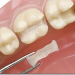 Что такое вкладки при протезировании зубов