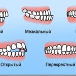 Исправление прикуса: виды систем, сроки лечения и советы по выбору врача