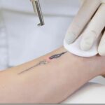 Сведение тату в Красноярске — стоимость и процедуры удаления